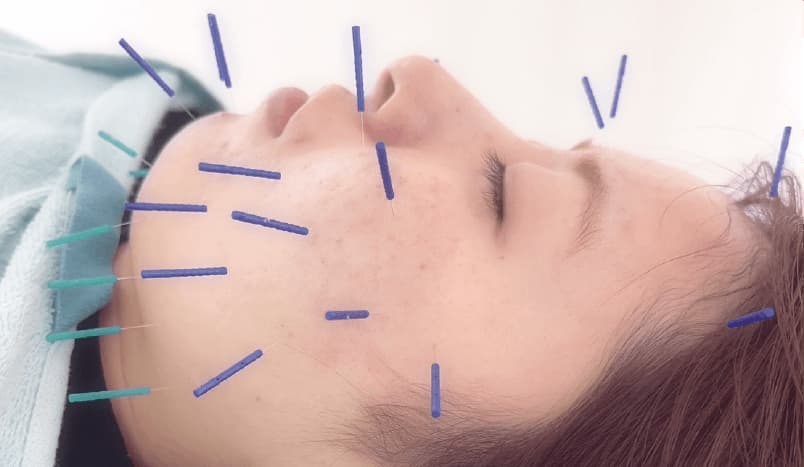 美容鍼